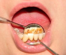 牙结石是怎样的形成的？