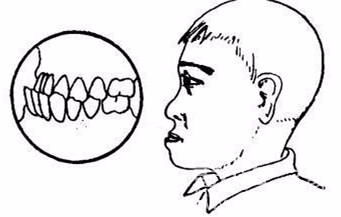 谈谈骨性反颌与牙性反颌的区别