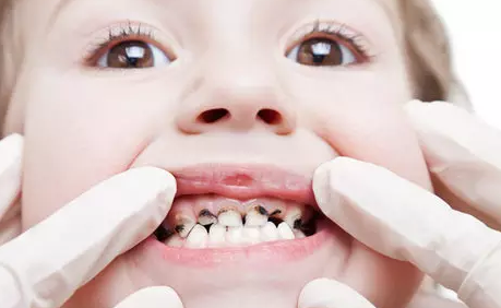有了龋齿必须得补牙吗？