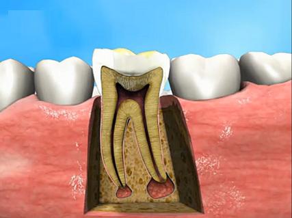 天津种植牙医院海德堡口腔专家讲解，急性根尖周炎的治疗