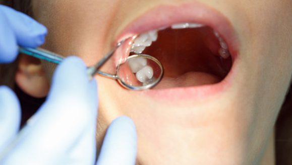 天津种植牙医院海德堡口腔告诉你哪些智齿需要拔除