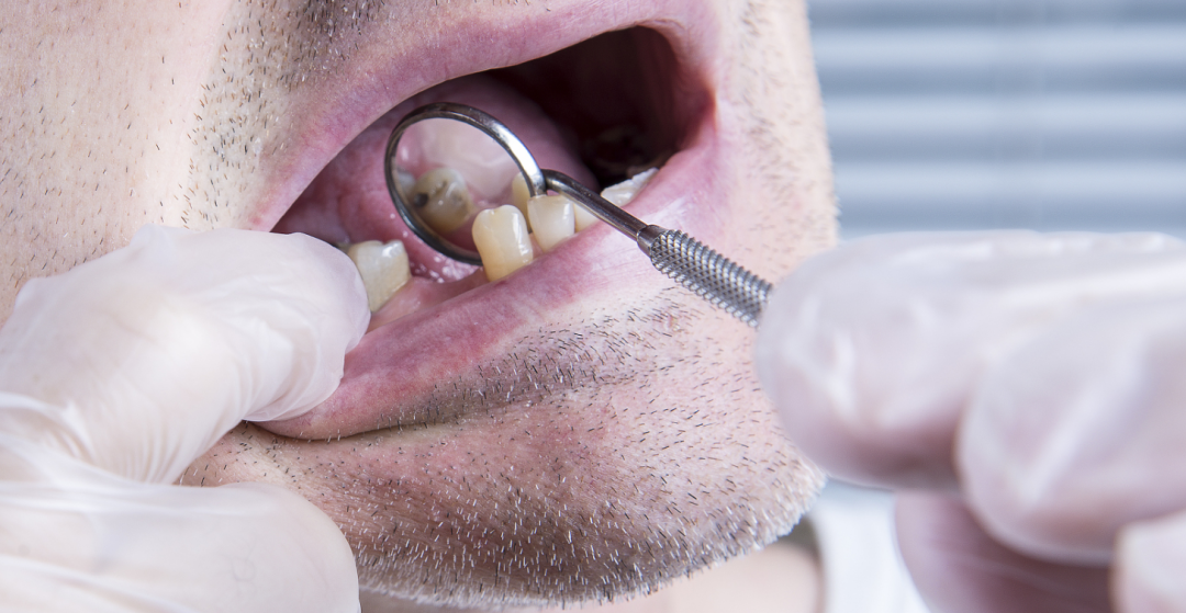 种植牙会损坏牙槽骨？起决定性的因素竟有这些!