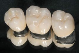 天津海德堡口腔专家讲解烤瓷牙修复注意事项