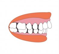 不同年龄段的牙齿稀疏的治疗方法有何不同？