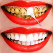 外因性色素牙的形成和影响有哪些？