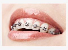 隐形牙套成为当前牙齿矫正患者的“首选”
