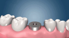 种植牙可以缓解牙疼是谣言？
