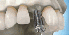 为何缺牙患者如此信赖种植牙？