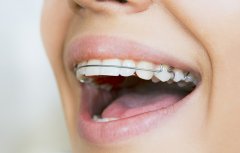 龅牙主要分为以下三种类型
