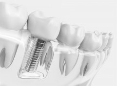 天津海德堡单颗牙齿缺失较好的修复方法是什么？