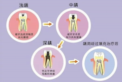 天津市海德堡联合口腔医院医生科普关于龋齿我们该怎么办？