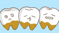 天津海德堡联合口腔医生讲解预防牙结石很重要