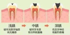 天津海德堡联合口腔带你了解龋齿应该如何护理才好