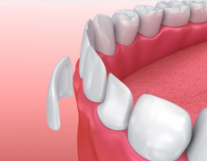 天津海德堡联合口腔医生讲解牙齿贴面的美白效果怎么样！