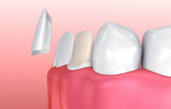 天津海德堡联合口腔医生讲解牙齿贴面需要注意的事情！