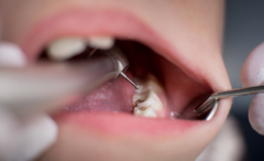 天津海德堡联合口腔医生讲解补牙的过程！