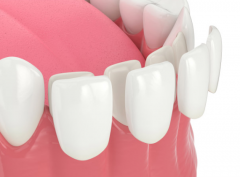 天津海德堡联合口腔医生讲解牙齿贴面是怎么回事？