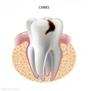 天津海德堡联合口腔医生讲解牙齿是如何 从【浅龋】到【拔牙】！