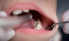 天津海德堡联合口腔医生讲解儿童牙齿如何护理？