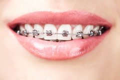 天津海德堡联合口腔医生讲解牙齿矫正与年纪有关吗？